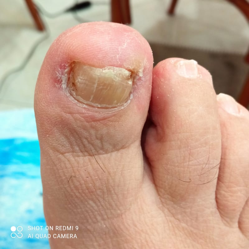 Trattamento Unghie Incarnite