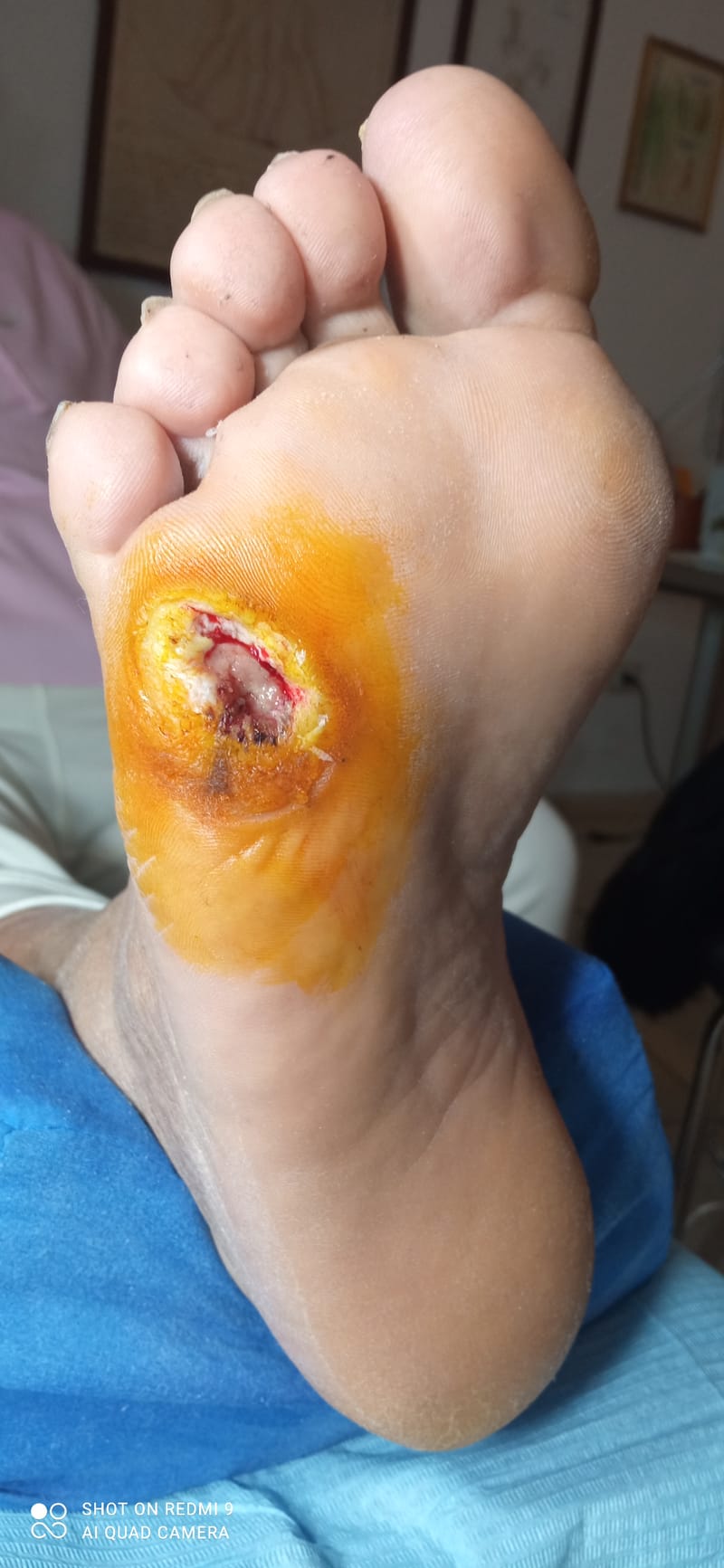 Piede diabetico