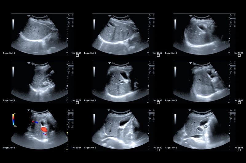 Liver disease in pregnancy