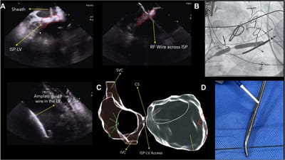 El Dr. Luis Quininir marca un hito en la electrofisiología latinoamericana