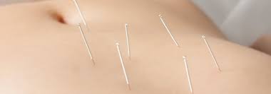 Acupuntura