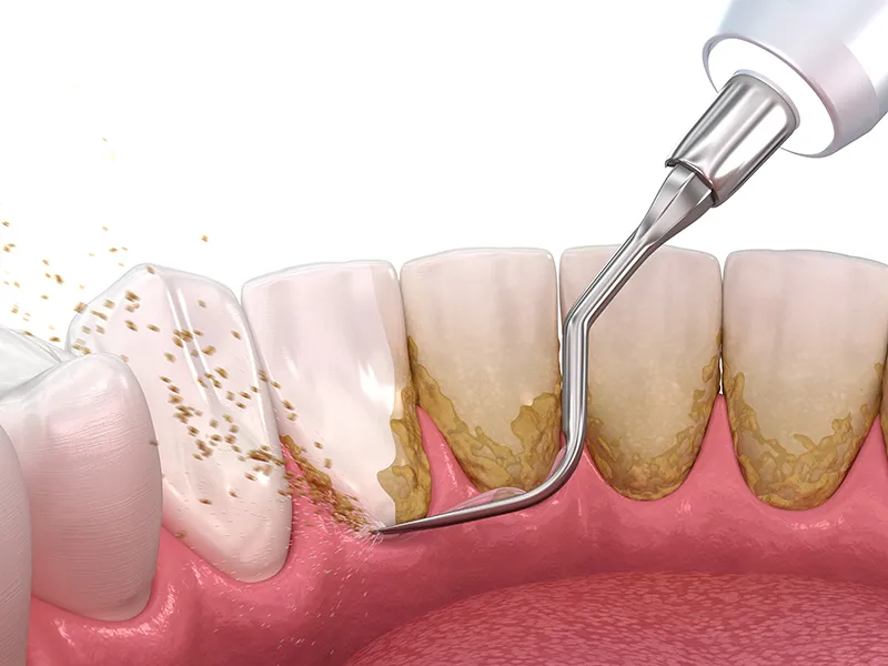 طب الأسنان التجميلي