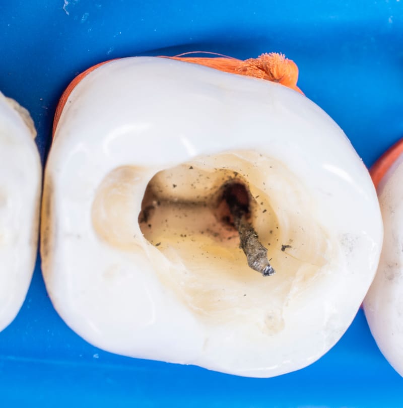 טיפולי שורש לילדים