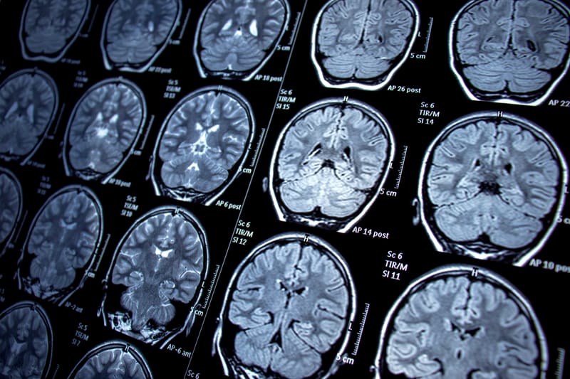 Epilepsy in Korean Language