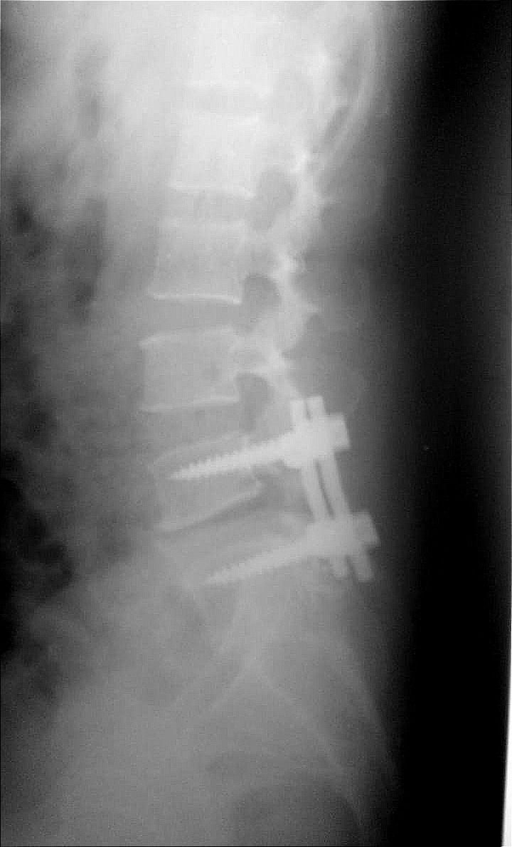 Spinal Injuries