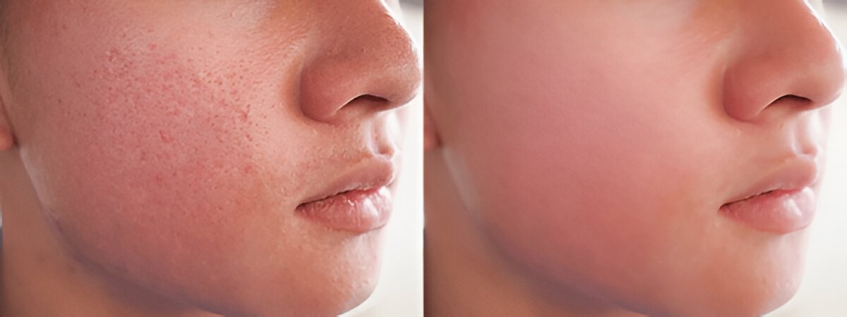 Open Pores Treatment