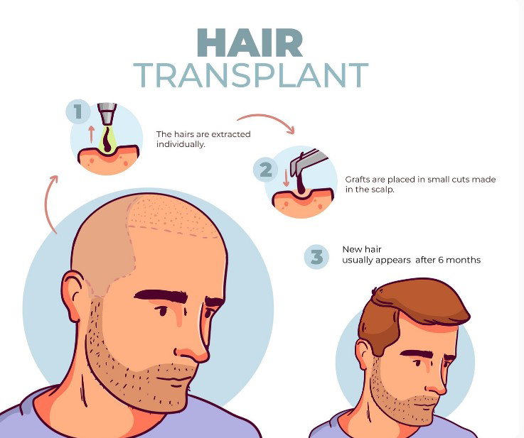 Hair transplant