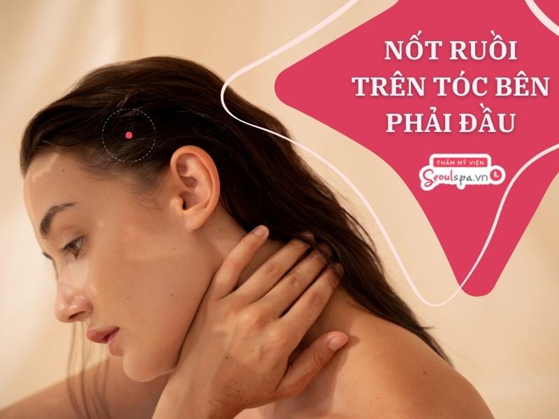 Nốt ruồi trong tóc tốt hay xấu