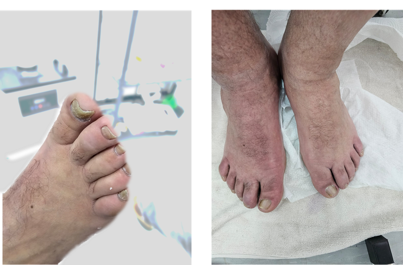 פדיקור פרה רפואי - לפני ואחרי