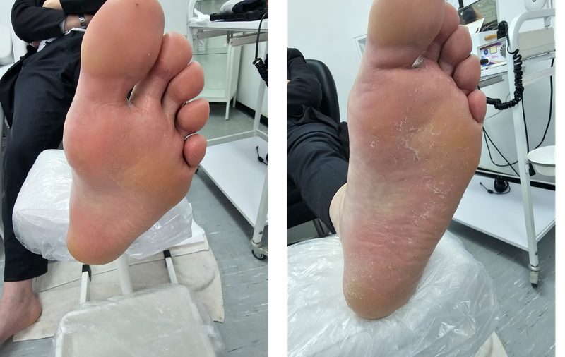 טיפול ביובש כף הרגל - לפני ואחרי