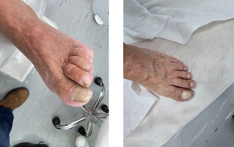 טיפול בציפורן קשה  לפני ואחרי