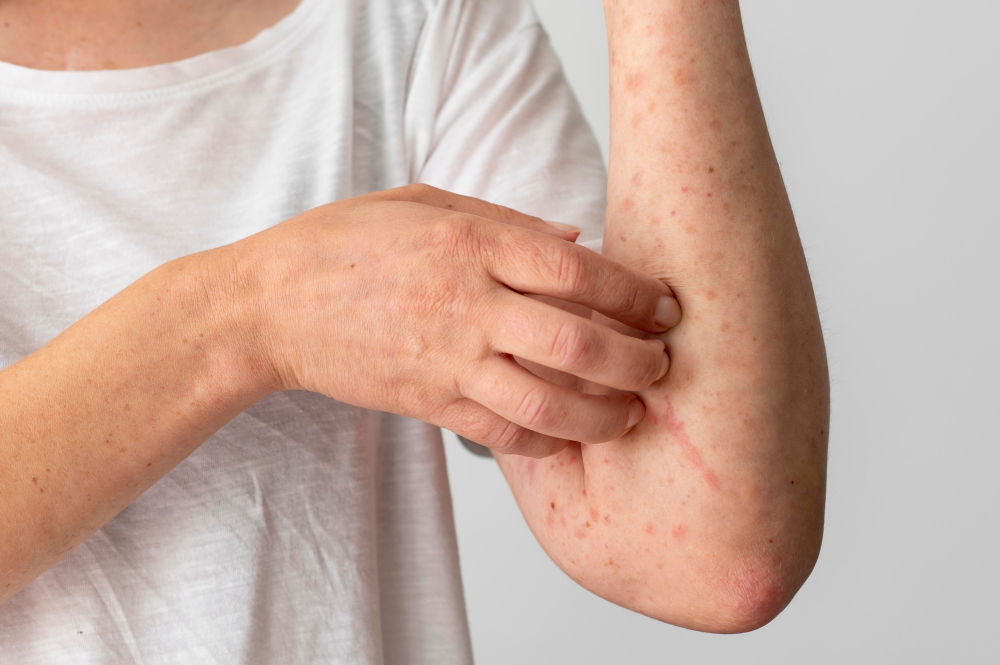 Water Allergy: What You Should Know About Aquagenic Urticaria
