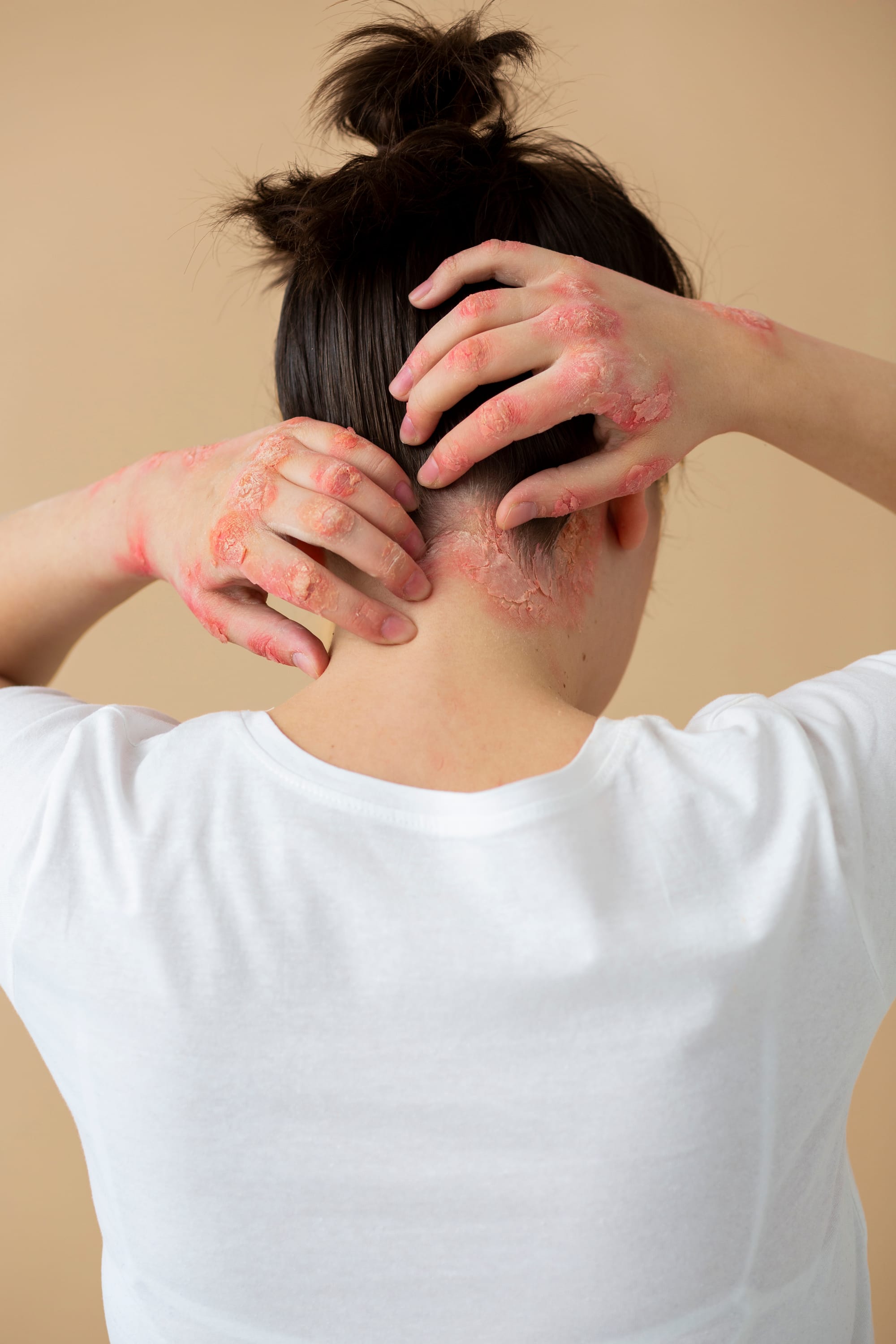 What Is Psoriasis? Types, Symptoms, and Triggers Explained