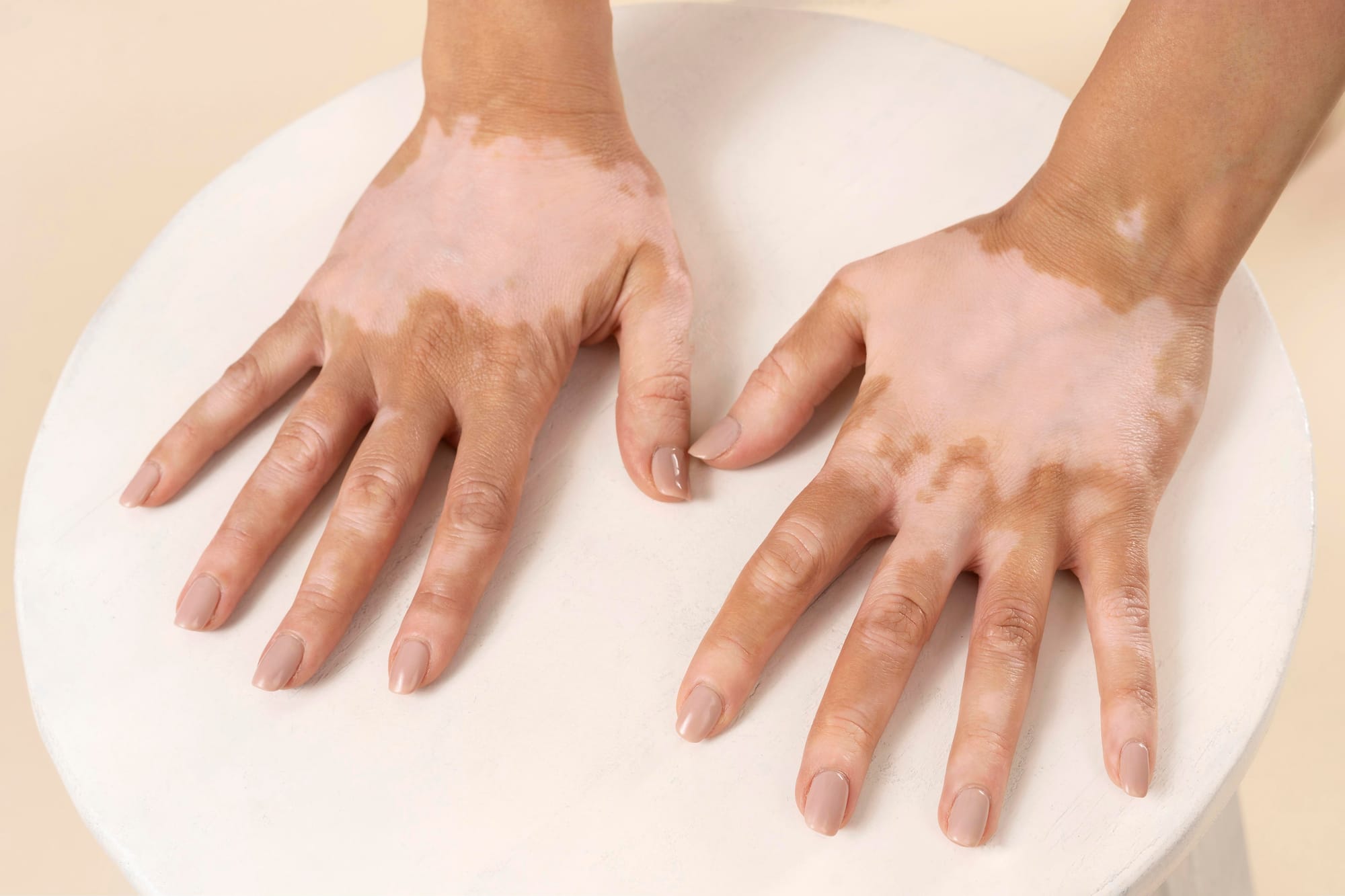 Vitiligo: Causes, Symptoms, and Treatment Options