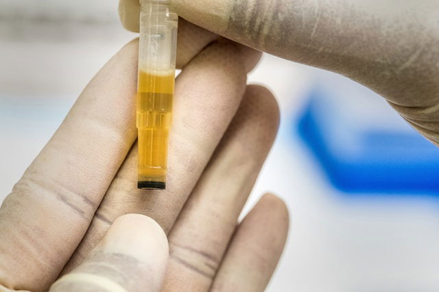 What Your Urine Colour Means for Your Health