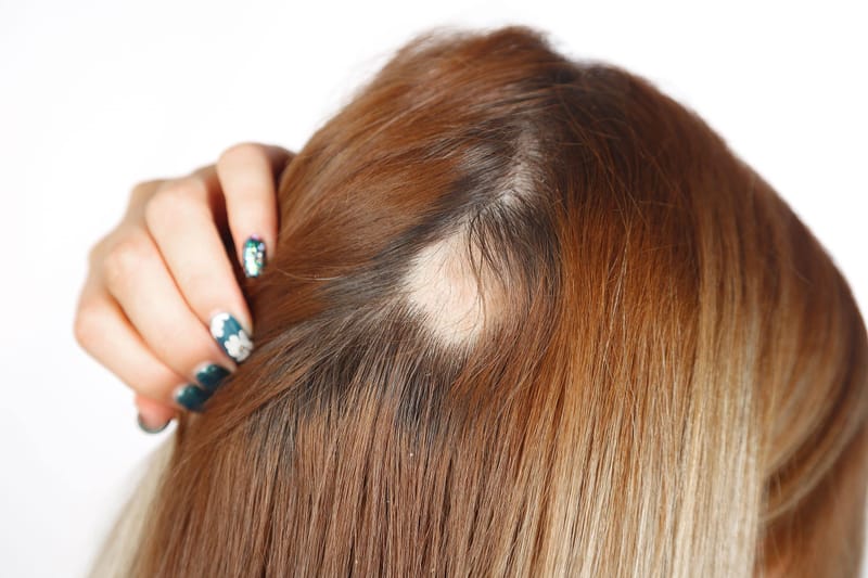 Łysienie plackowate