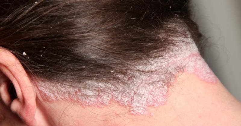 Łuszczyca Głowy