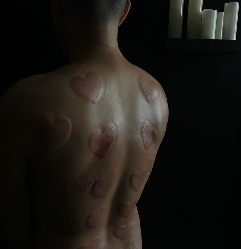 CUPPING THERAPY