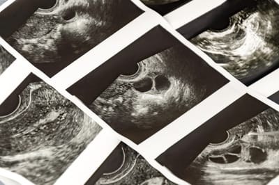 أهم 15 سؤالا وإجابة عن أطفال أنابيب للنساء والتوليد في eve clinic