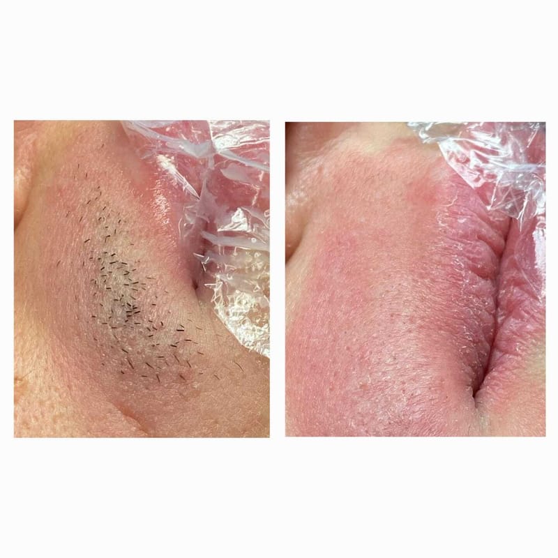 אפילציה בשפם.