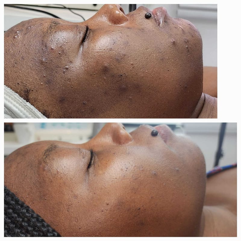 אקנה טיפול 1