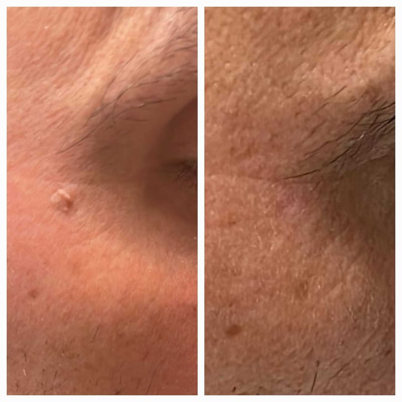 הסרת פפילומה בפנים