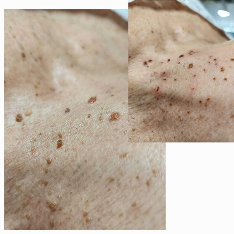 פפילומות באזור הצוואר