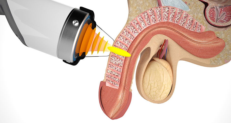 Traitement non chirurgical de la dysfonction érectile