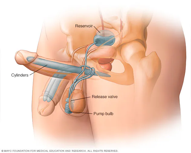 Prothèse pénienne hydraulique en Turquie : guide complet, chirurgie, récupération, prix et questions fréquentes