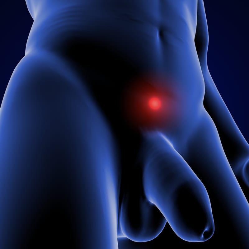 Approche infrapubienne mini-invasive pour la prothèse pénienne gonflable : résultats péri-opératoires et à moyen terme