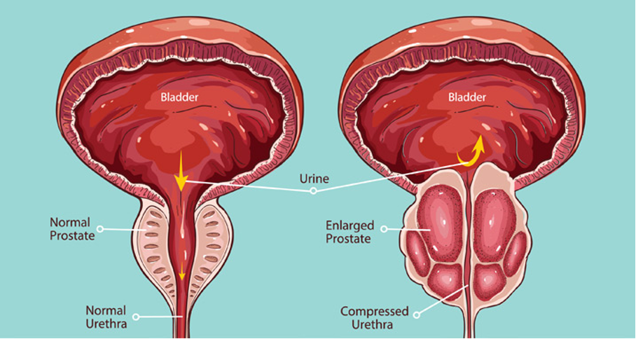 Traitez vos infections urinaires et problèmes de prostate à Istabul