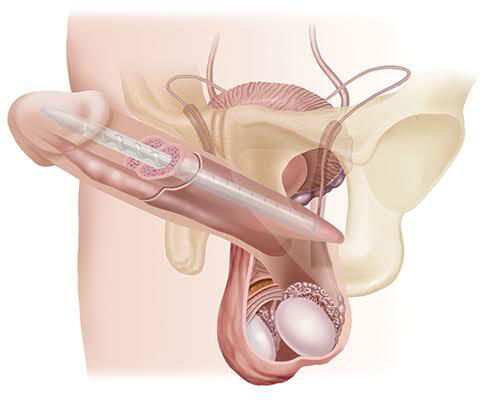 Implant pénien à Istanbul 