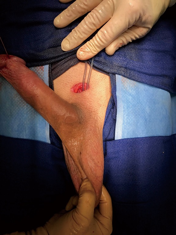 phantom (The infrapubic surgical approach for inflatable penile prosthesis placement)