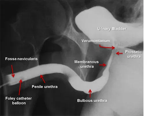 infection urinaire