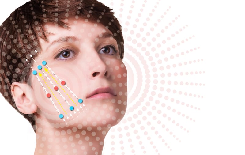 Fios de Sustentação ( Lifting Facial)