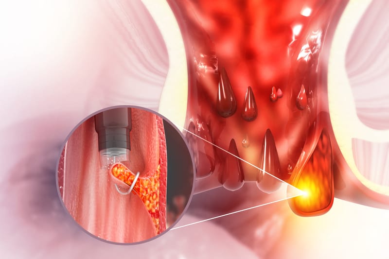 Cirurgia para Hemorróida