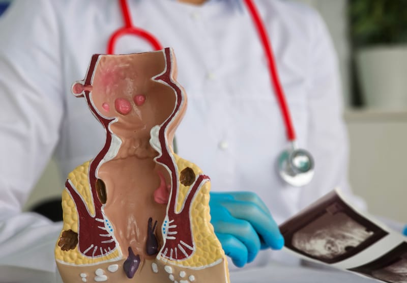 Cirurgia para Fissura Anal