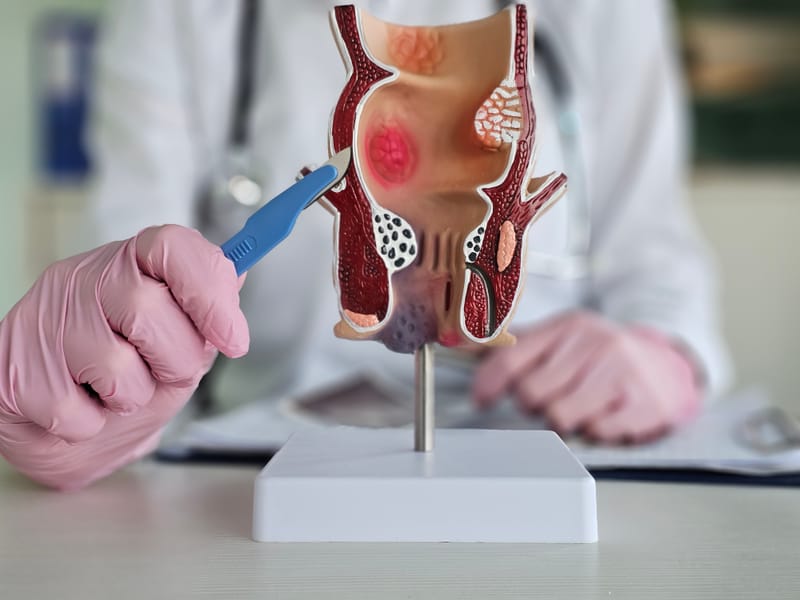 Cirurgia para Fístula Anal