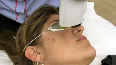 How to Prepare for Your First Pico Laser Session