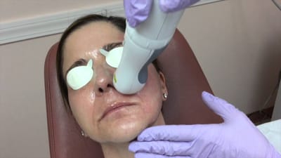 Can Pico Laser Give You the Clear Skin You’ve Always Wanted?