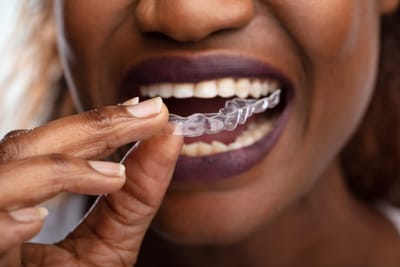 Invisalign Treatment Cost for Adults vs Teens