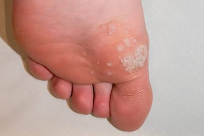 How to Save Money on Skin Wart Removal