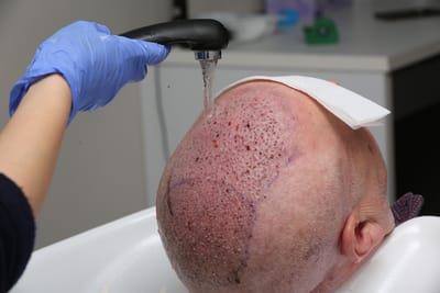 Is the Cost of a Hair Transplant Worth the Result?