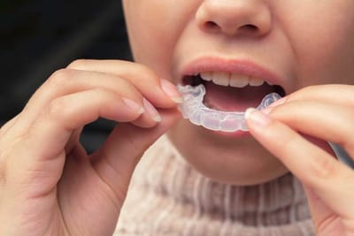 How to Save on Your Invisalign Braces Treatment