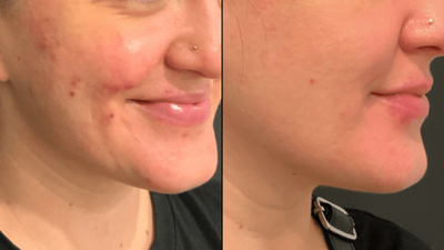 Transform Your Skin with Pico Laser Treatment for Scarring