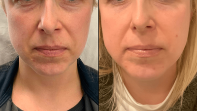 Pico Laser Treatment for Skin Aging: A Powerful Anti-Aging Solution