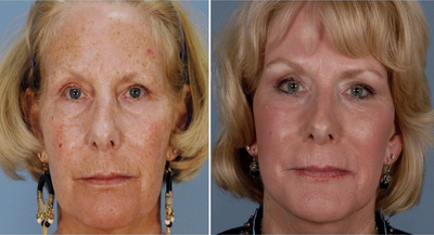 Fractional CO2 Laser Treatment Cost: A Closer Look at the Price Factors
