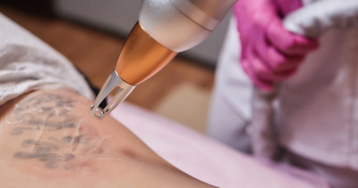Pico Laser Treatment for Dark Spots: A Non-Invasive Solution