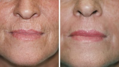 How Much Does Fractional CO2 Laser Cost for Fine Lines and Wrinkles?