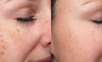 Pico Laser Treatment for Large Pores: Can It Help?